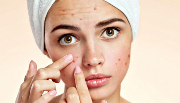 acne-shutterstock-770x470