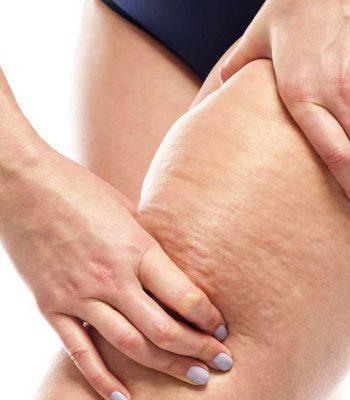 cellulite-disease