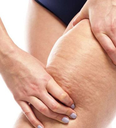 cellulite-disease