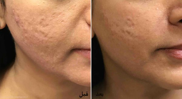 microneedling-1