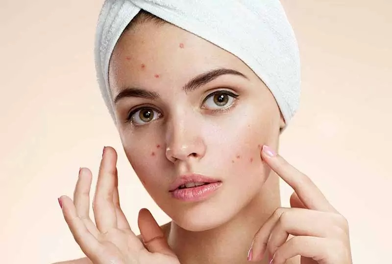 what-is-acne